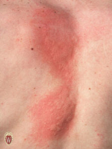 The wheals on the back of this16-year-old boy are an example of urticaria (or hives).