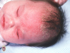 The greasy yellow scale on the scalp of this 3-month-old girl is a classic case of seborrheic dermatitis (otherwise known as cradle cap)