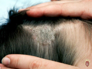 This scale is in the scalp and on the hairs of a 3-year-old boy with a fungus infection of the scalp, tinea capitis.