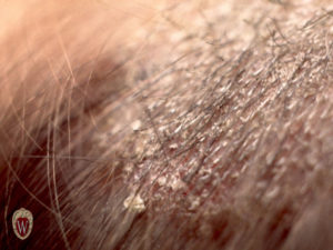 This scale is in the scalp and on the hairs of a 3-year-old boy with a fungus infection of the scalp, tinea capitis. This is a more detailed picture from the same patient as the previous image.