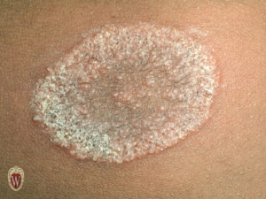This plaque of tinea corporis (cutaneous fungal infection) is a papulosquamous lesion.