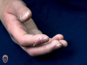 Desquamation of fingertips is associated with Kawasaki disease in an 8-year-old boy.