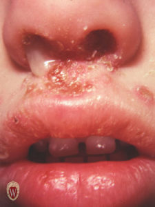 The honey-colored adherent crusts of this peri-oral lesion are classic for impetigo in this young man.
