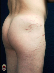 This 15-year-old boy has linear areas of atrophy (striae) secondary to chronic systemic steroid administration.