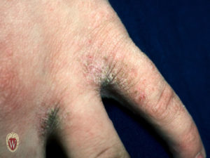 This 13-year-old girl with very pruritic scabies has lichenification of the skin of the web spaces between her fingers.