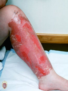 The extensive erosions on the leg of this 18-year-old woman are the consequences of a self-inflicted chemical burn.