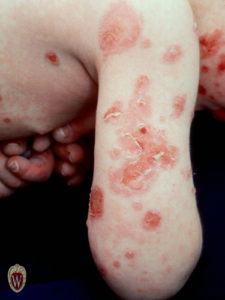 The erosions on the back of the arm of this 4-year-old boy are the base of the unroofed bullae associated with Stevens-Johnson syndrome.