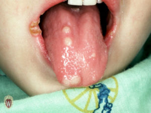 This 5-year-old girl has a fissure at the angle of her lips (and plaques on her tongue) as a consequence of Kawasaki disease.