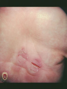 This patient has a fissure of the palm of her hand.