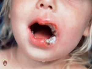 This 3-year-old girl has an extensive ulceration of her lips after having chewed on a live electrical wire.
