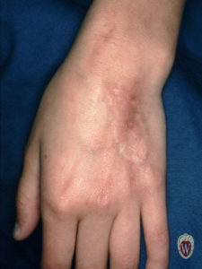This 13-year-old girl has a scar on the back of her hand where vincristine being given intravenously infiltrated her skin.