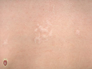 The two photographs of this 12-year-old boy were taken approximately 1-1/2 years apart. They show the clustered vesicles of varicella zoster and the hypopigmented scar tissue which subsequently developed at the site.