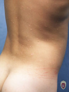 This 6-year-old boy has hypopigmented scars from a prior varicella infection