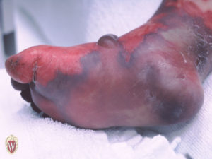 This eschar covers an area of necrosis on the foot of a 15-month-old boy with meningococcemia.