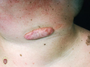 This 14-year-old boy has a keloid at the site of an old lymph node biopsy site. Note the unaffected scar site on the right side of the keloid.