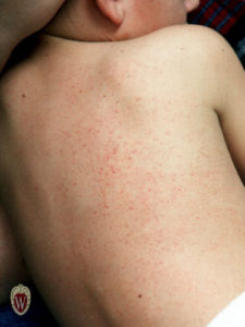 This 7-year-old boy has petechiae from thrombocytopenia secondary to chemotherapy.