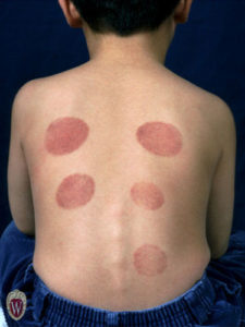 The purpura on the back of this 6-year-old boy are known as suction purpura. They are caused by the medical practice of cupping which has its origins in antiquity.