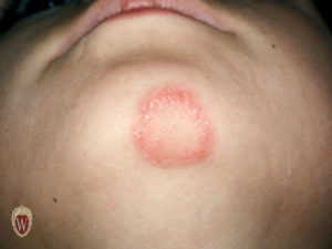 This patient has tinea corporis in a classic annular pattern.