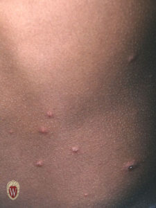 This 8-year-old boy has the vesicles of varicella in a discrete pattern.