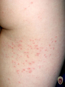 These vesicles in an 8-year-old boy with varicella are clustered on the posterior thigh.