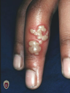 In this 11-year-old girl, vesicles of herpes simplex have run together and become confluent.