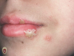 The vesicles of herpes simplex in this 9-year-old girl are both confluent and clustered.