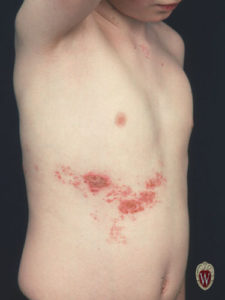 Here is the classic lesion of varicella zoster following the dermatome T7 in this 12-year-old boy.