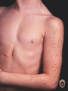  In this example the patient has nevi which follow a dermatome in a zosteriform nevus.