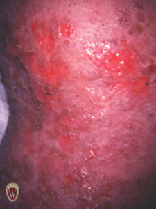 This patient has atopic dermatitis. The patient has weeping, scaling, and crusting.
