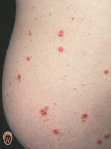 This 18-year-old male has one form of psoriasis known as guttate psoriasis.