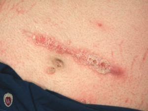 This patient with psoriasis has the scaly psoriatic lesions along the line of a ventral hernia repair.