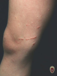 This patient has poison ivy dermatitis with the classic and helpful finding of a linear streak of vesicles, where the rash-producing resin from the plant brushed against his leg.