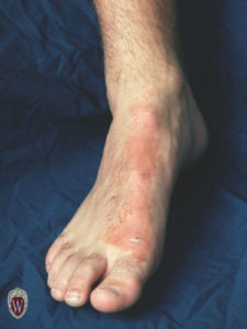 This 18-year-old young man has lymphangitis from an infected lesion on his foot, with linear streaking following the line of the lymph system.