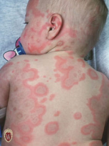 This patient (a 13-month-old baby girl) with erythema multiforme (the paradigm of conditions with multiform lesions) has target lesions, urticarial lesions, and annular lesions.