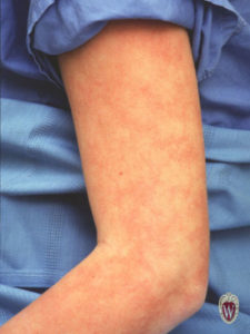 This 14-year-old girl has livedo reticularis.