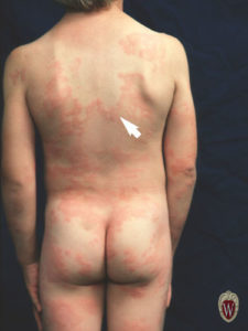 The urticaria in this 5-year-old boy have followed a very serpiginous route.