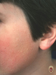This 10-year-old boy has a common finding of the skin, keratosis pilaris. Keratosis pilaris is caused by large cornified plugs in the upper part of hair follicles.