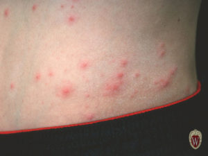 The pustules that this 10-year-old boy has are all centered around hair follicles. He has folliculitis.