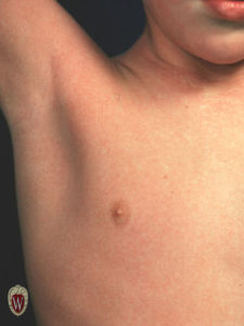 The scarlatiniform rash in this 5-year-old boy is associated with scarlet fever.