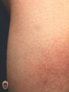 The pinpoint papules of scarlet fever show clearly on the skin of this 6-year-old girl.