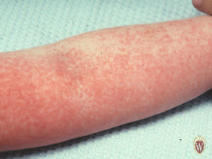 This 34-month-old boy has a scarlatiniform rash from serum sickness.