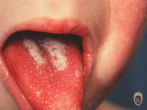 This 3-year-old boy with scarlet fever has a strawberry tongue.