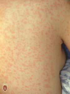 This 12-year-old girl has a morbilliform rash from the disease measles.