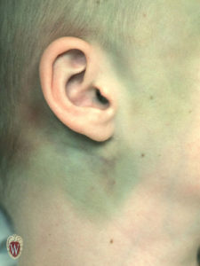 The bruise behind the ear in this 8-year-old male is associated with a basilar skull fracture and is called Battle sign.