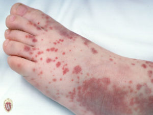 The palpable purpura on the foot of this nearly 3-year-old boy are associated with the disease Henoch-Schönlein Purpura.