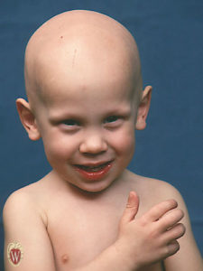This 2-1/2-year-old boy has alopecia universalis. He has the complete absence of hair on his body, including the absence of eyelashes and eyebrows.
