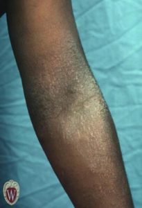 This 7-year-old boy has atopic dermatitis in his antecubital fossa.